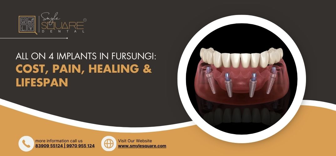 All on 4 Implants in Fursungi: Cost, Pain, Healing & Lifespan